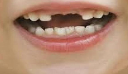 تفسير حلم وقوع الاسنان 